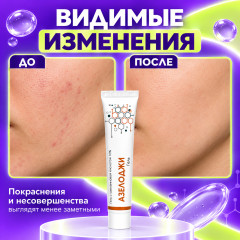 Гель от акне и прыщей с азелаиновой кислотой 10% для лица Азелоджи, 30 г - Фото 2