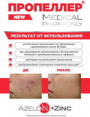 Лосьон для лица дерматологический «Azeloin + Zinc» - Фото 6