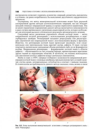 Дентальная имплантация