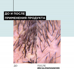 Шампунь для волос против перхоти - Фото 5