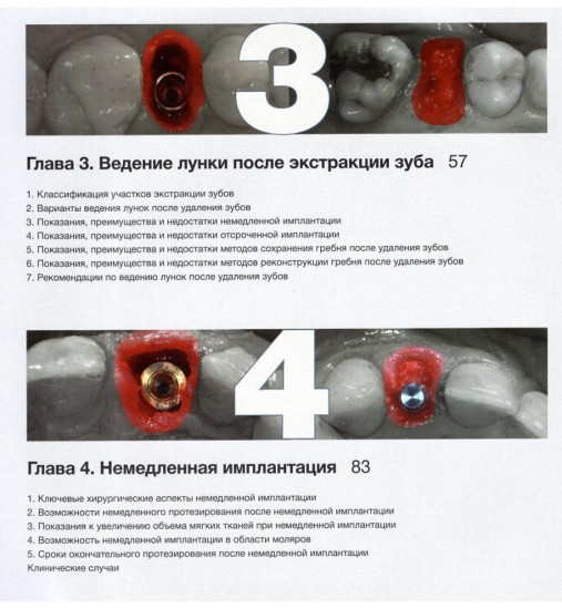 Эстетика мягких тканей в имплантологии