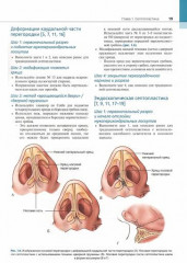 Атлас эндоскопической хирургии околоносовых пазух и основания черепа - Фото 2