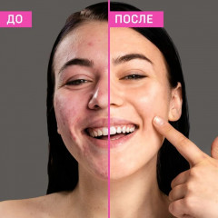 Пенка для умывания против прыщей - Фото 4