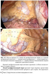 Торакоскопическая радиочастотная фрагментация левого предсердия - Фото 4