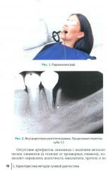 Рентгенологическая оценка качества имплантационного протезирования - Фото 3