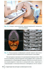 Рентгенологическая оценка качества имплантационного протезирования - Фото 4