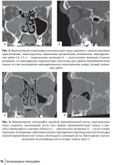 Современные аспекты диагностики и лечения одонтогенного верхнечелюстного синусита. Руководство для врачей - Фото 5