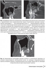 Современные аспекты диагностики и лечения одонтогенного верхнечелюстного синусита. Руководство для врачей - Фото 6