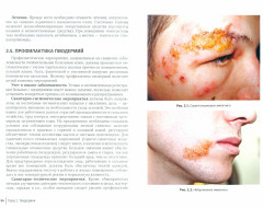 Инфекционные болезни кожи - Фото 1