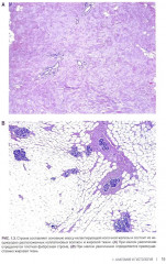 Интерпретация биопсий молочной железы - Фото 6