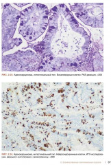 Морфологическая диагностика опухолей носа, околоносовых пазух и носоглотки. Руководство-атлас - Фото 6