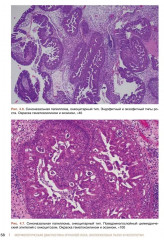 Морфологическая диагностика опухолей носа, околоносовых пазух и носоглотки. Руководство-атлас - Фото 8