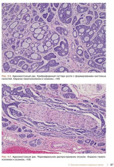 Морфологическая диагностика опухолей носа, околоносовых пазух и носоглотки. Руководство-атлас - Фото 9