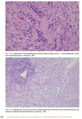 Морфологическая диагностика опухолей носа, околоносовых пазух и носоглотки. Руководство-атлас - Фото 11