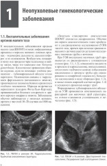 Тазовые боли у женщин. Дифференцианальная диагностика лучевыми методами - Фото 3