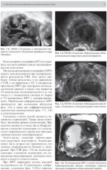 Тазовые боли у женщин. Дифференцианальная диагностика лучевыми методами - Фото 4