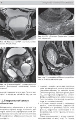 Тазовые боли у женщин. Дифференцианальная диагностика лучевыми методами - Фото 5