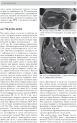 Тазовые боли у женщин. Дифференцианальная диагностика лучевыми методами - Фото 8