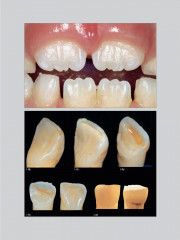 Адгезивные керамические реставрации передних зубов - Фото 6