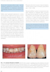 Адгезивные керамические реставрации передних зубов - Фото 7