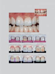 Адгезивные керамические реставрации передних зубов - Фото 10
