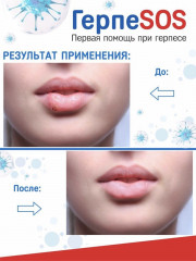 Крем-гель «ГерпеSOS» - Фото 4