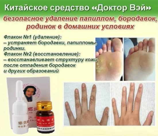 Средство для удаления бородавок, родинок и папиллом