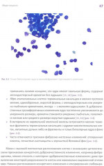 Йокогамская система интерпретации результатов тонкоигольной аспирационной биопсии молочной железы - Фото 8