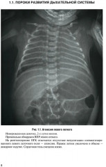 Неотложная рентгенодиагностика в неонатологии и педиатрии - Фото 3