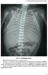 Неотложная рентгенодиагностика в неонатологии и педиатрии - Фото 4