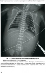Неотложная рентгенодиагностика в неонатологии и педиатрии - Фото 5