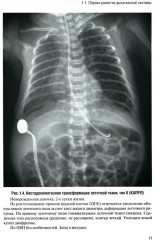 Неотложная рентгенодиагностика в неонатологии и педиатрии - Фото 6