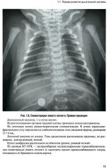 Неотложная рентгенодиагностика в неонатологии и педиатрии - Фото 10