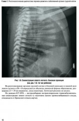 Неотложная рентгенодиагностика в неонатологии и педиатрии - Фото 11