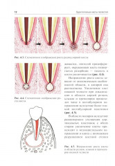Одонтогенные кисты челюстей - Фото 6