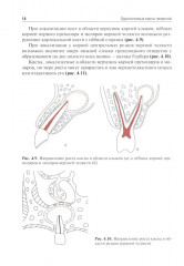 Одонтогенные кисты челюстей - Фото 8