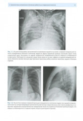 Рентгенологическая диагностика огнестрельных ранений и повреждений грудной полости - Фото 4