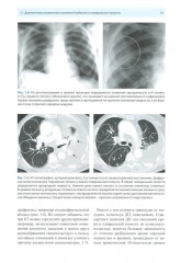 Рентгенологическая диагностика огнестрельных ранений и повреждений грудной полости - Фото 6