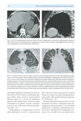 Рентгенологическая диагностика огнестрельных ранений и повреждений грудной полости - Фото 7
