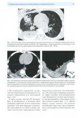 Рентгенологическая диагностика огнестрельных ранений и повреждений грудной полости - Фото 8