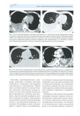 Рентгенологическая диагностика огнестрельных ранений и повреждений грудной полости - Фото 9