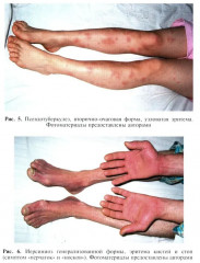 Инфекционные болезни - Фото 13