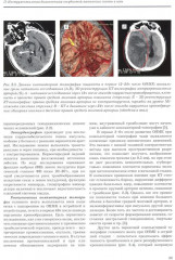 Хирургическая реваскуляризация головного мозга - Фото 5
