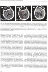 Хирургическая реваскуляризация головного мозга - Фото 6
