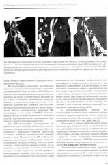 Хирургическая реваскуляризация головного мозга - Фото 7