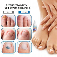 Капли для лечения ногтевого грибка - Фото 2