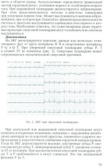 Аритмии сердца у детей и подростков - Фото 6