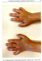 Синдром Сильвера-Рассела: клиника, диагностика, лечение - Фото 5