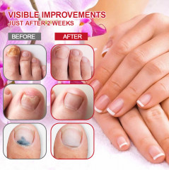 Капли от грибка ногтей - Фото 2