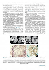 Краниофарингиомы - Фото 6